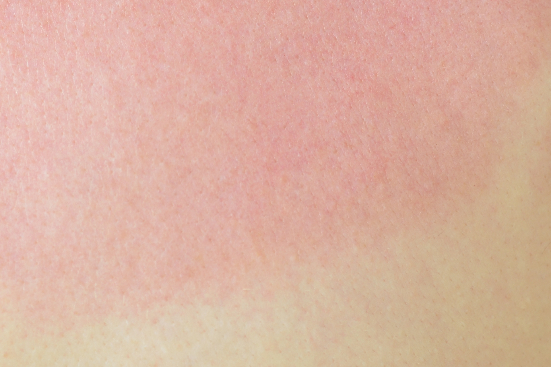 đỏ da ngay khi tiếp xúc với tia UV ngay cả khi thời tiết hanh khô