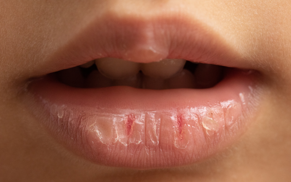 Cách dầu dừa trị thâm môi là tác động từ việc dưỡng ẩm để làm sáng màu môi