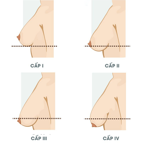 Các mức độ chảy xệ ngực sau sinh