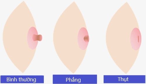 Núm ti của Mẹ bị thụt