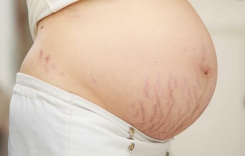 Bụng Rạn: Cách Chăm Sóc Da Hiệu Quả Để Làm Mờ Sẹo Hiệu Quả Và Tái Tạo Làn Da