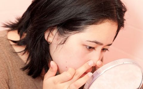 Cách Nặn Mụn Đầu Đen Và Điểm Danh Các Sản Phẩm Ngăn Ngừa Mụn Đầu Đen Hiệu Quả