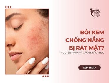 Bôi kem chống nắng bị rát mặt? Nguyên nhân và cách khắc phục