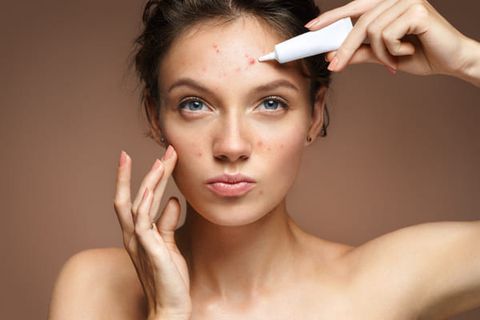 Bỏ Túi 5 Tuýp Trị Mụn Đáng Mua Nhất Cho Làn Da Của Bạn