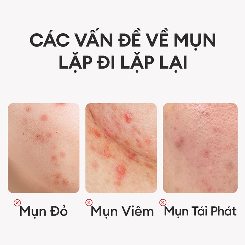 thegioiskinfood.com - Kem Hỗ Trợ Giảm Mụn Trà Xanh Colorkey Luminous Green Tea Purifying Acne Treatment 20g