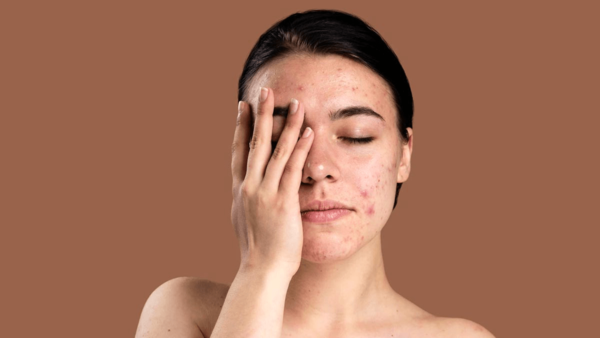 Gel trị mụn hỗ trợ điều trị tình trạng mụn trên da