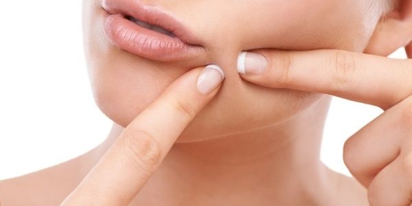 Mụn đầu đen gây mất thẩm mỹ và kém tự tin