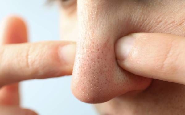 Mụn đầu đen thường phát triển tại vùng mũi nhiều nhất