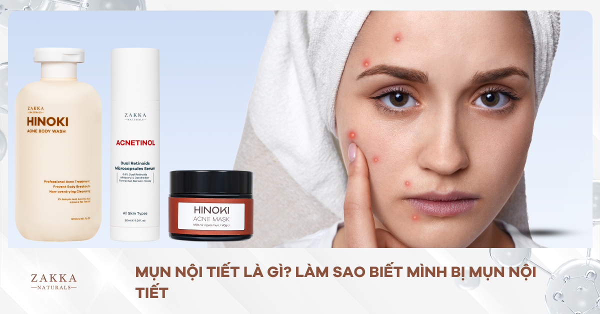 Mụn Nội Tiết Là Gì? Làm Sao Biết Mình Bị Mụn Nội Tiết