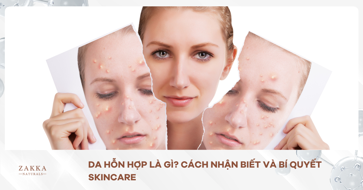 Da Hỗn Hợp Là Gì? Cách Nhận Biết Và Bí Quyết Skincare