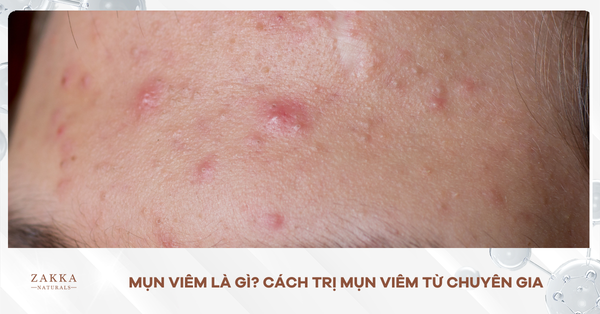 Mụn Viêm Là Gì? Cách Trị Mụn Viêm Từ Chuyên Gia
