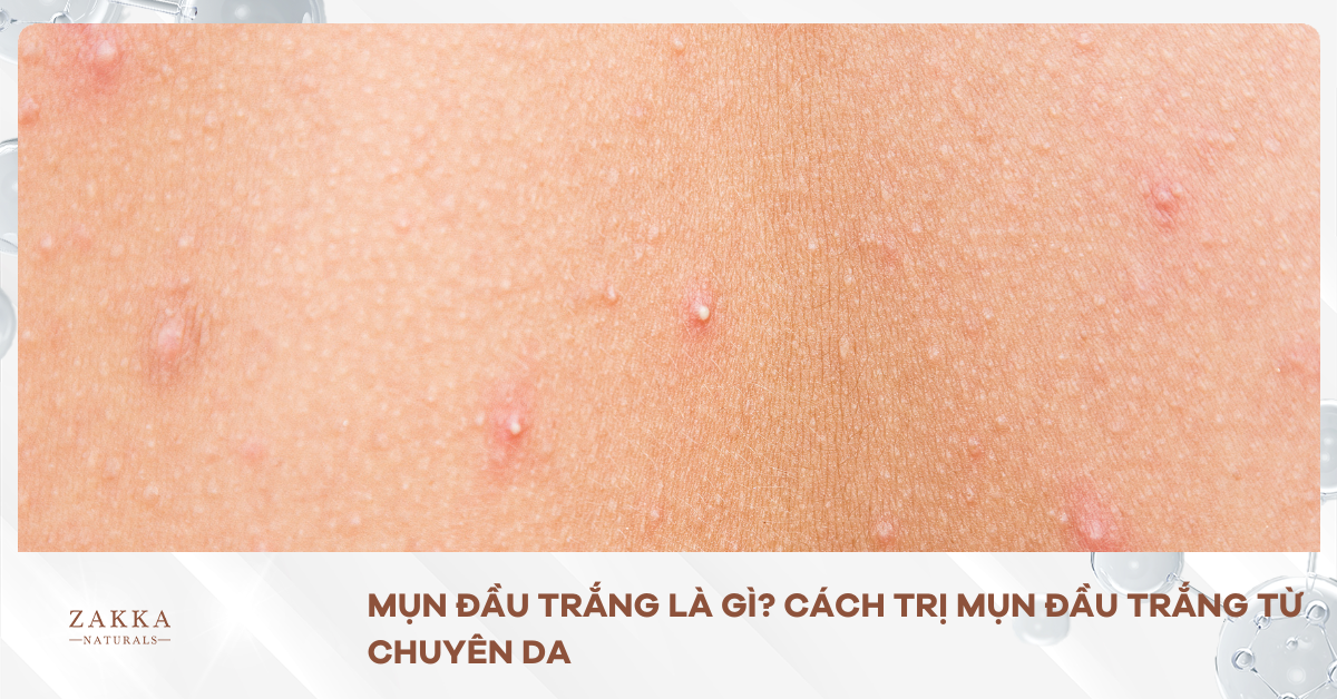 Mụn Đầu Trắng Là Gì? Cách Trị Mụn Đầu Trắng Từ Chuyên Da