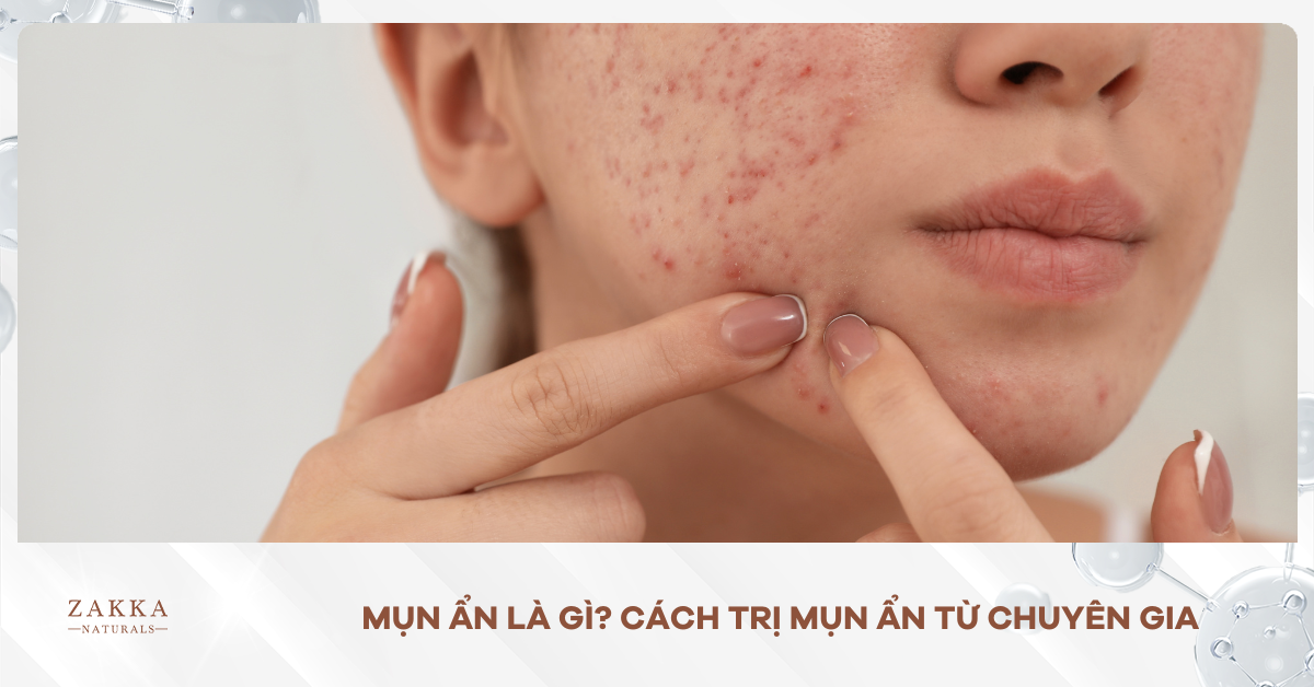 Mụn ẨnLà Gì? Cách Trị Mụn Ẩn Từ Chuyên Gia