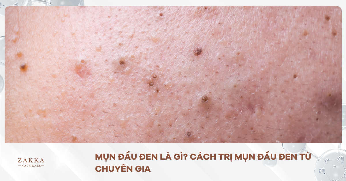 Mụn Đầu Đen Là Gì? Cách Trị Mụn Đầu Đen Từ Chuyên Gia