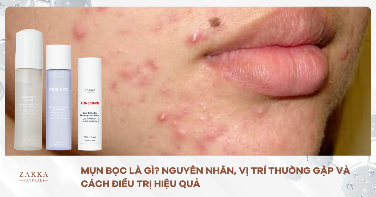 Mụn Bọc Là Gì? Nguyên Nhân, Vị Trí Thường Gặp Và Cách Điều Trị Hiệu Quả