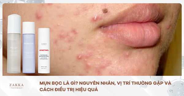 Mụn Bọc Là Gì? Nguyên Nhân, Vị Trí Thường Gặp Và Cách Điều Trị Hiệu Quả