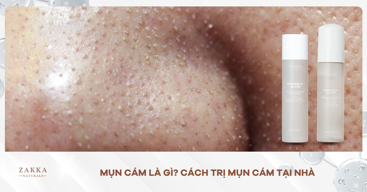 Mụn Cám Là Gì? Cách Trị Mụn Cám Tại Nhà