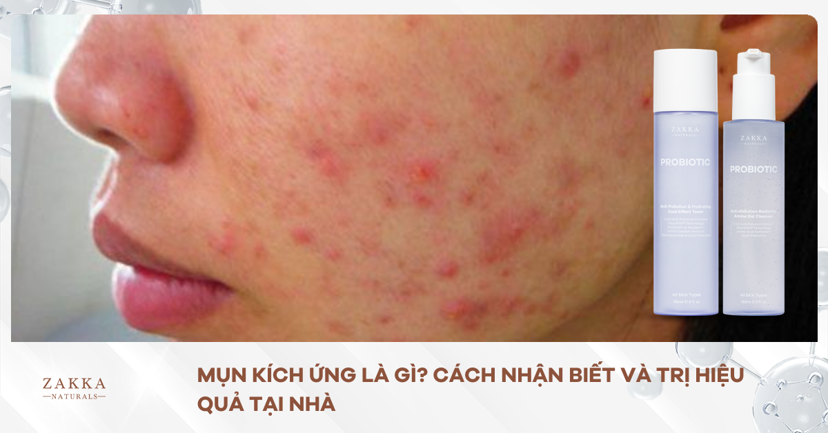 Mụn Kích Ứng Là Gì? Cách Nhận Biết Và Trị Hiệu Quả Tại Nhà