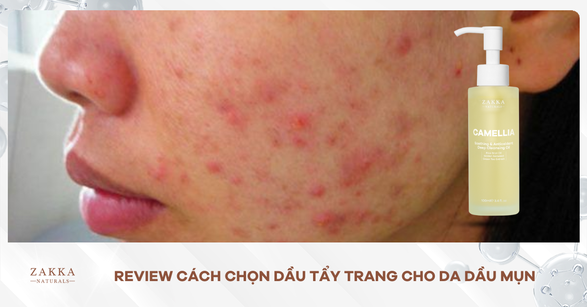 Review Cách Chọn Dầu Tẩy Trang Cho Da Dầu Mụn