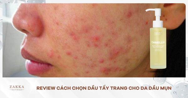Review Cách Chọn Dầu Tẩy Trang Cho Da Dầu Mụn