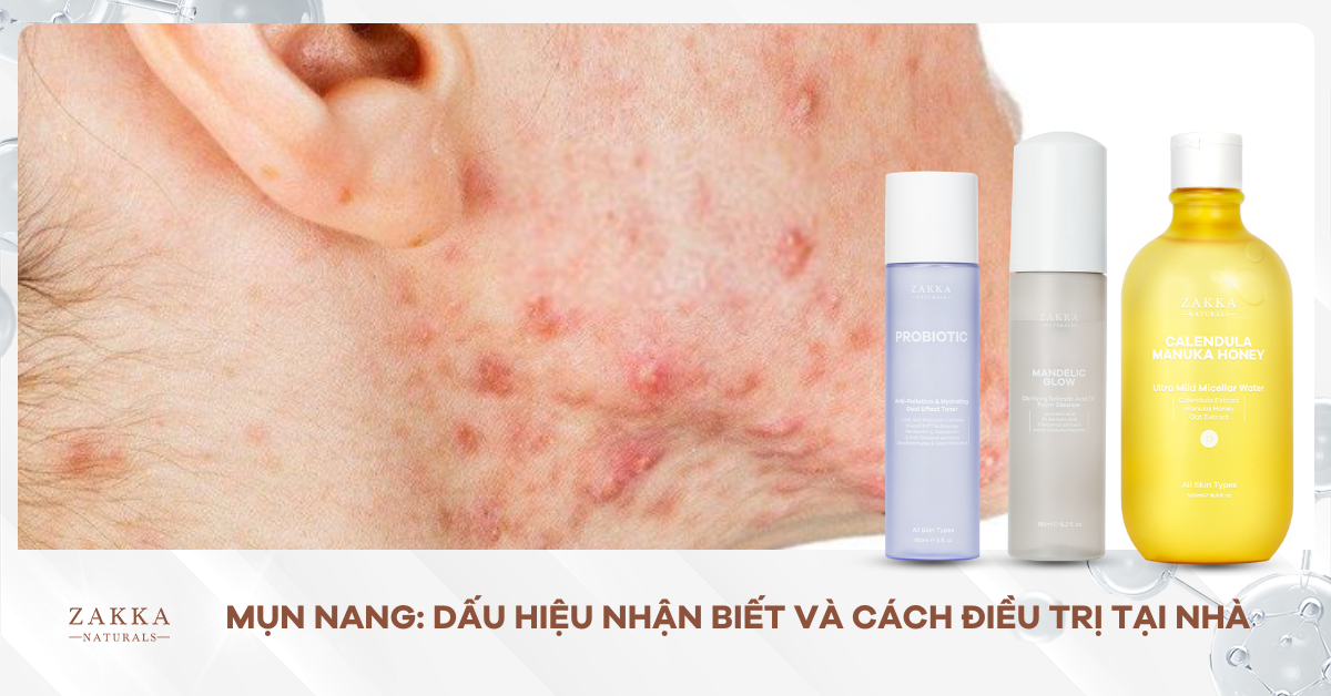 Mụn Nang: Dấu Hiệu Nhận Biết Và Cách Điều Trị Tại Nhà