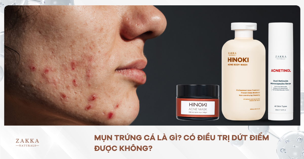 Mụn Trứng Cá Là Gì? Có Điều Trị Dứt Điểm Được Không?