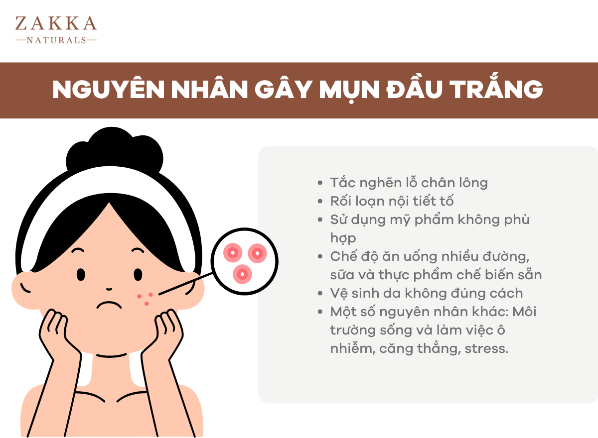 Mụn Đầu Trắng Là Gì? Cách Trị Mụn Đầu Trắng Từ Chuyên Da