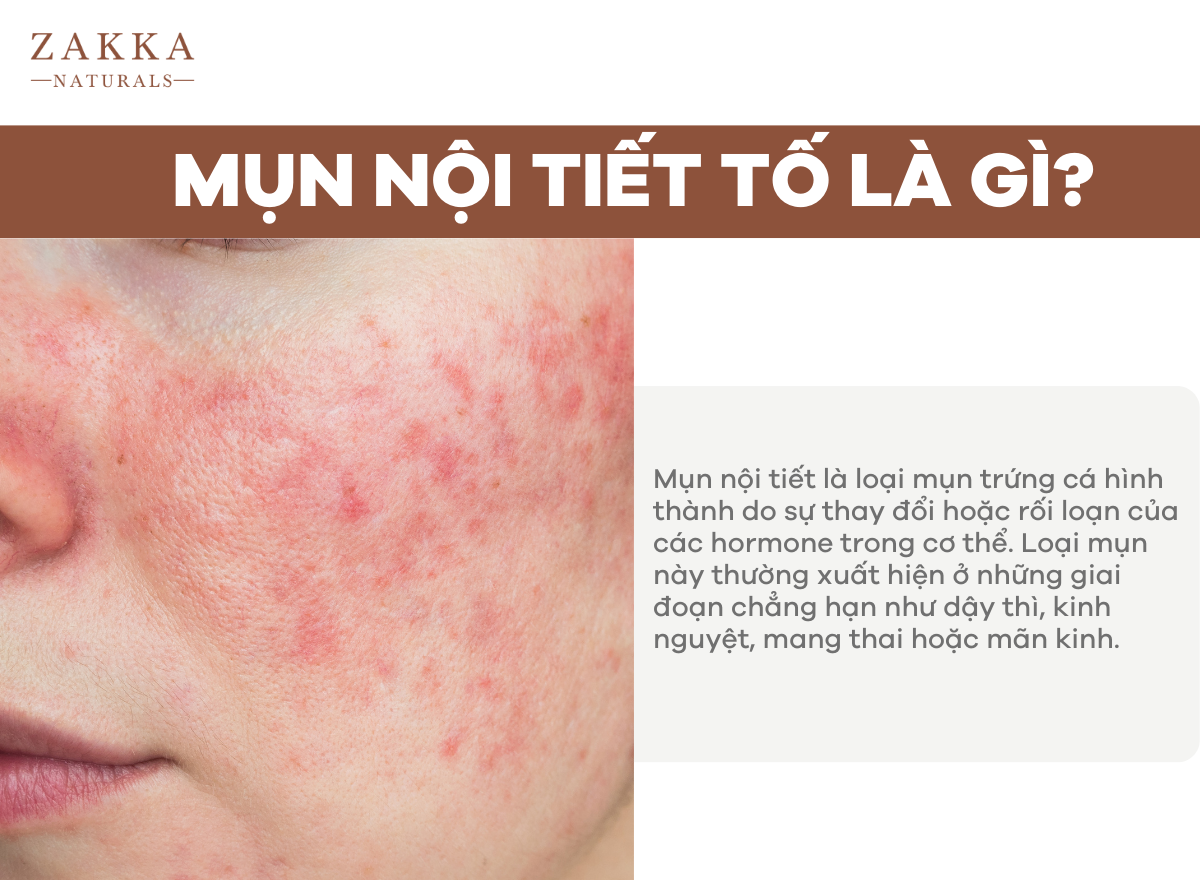 Mụn Nội Tiết Là Gì? Làm Sao Biết Mình Bị Mụn Nội Tiết