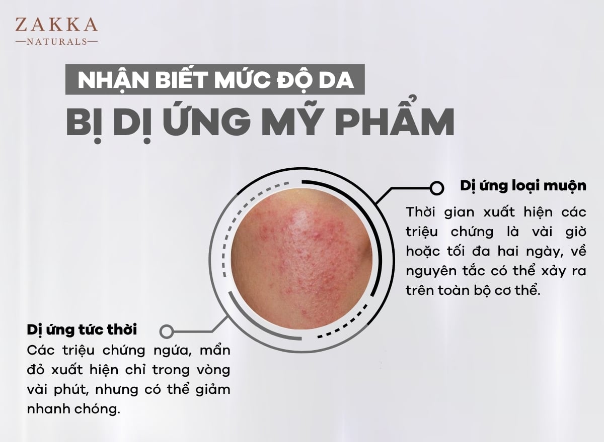 9 Cách Phục Hồi Da Hiệu Quả Sau Dị Ứng Mỹ Phẩm