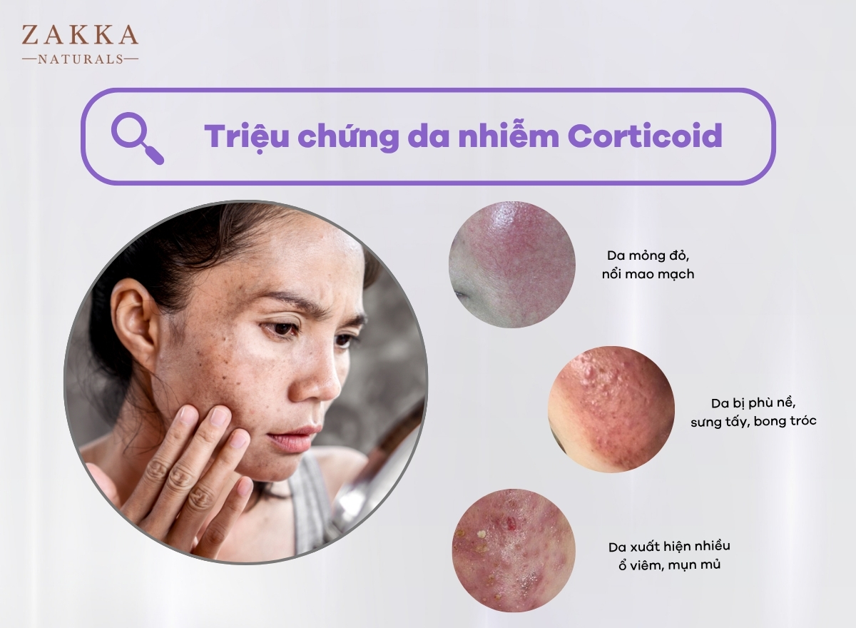 7 Cách Phục Hồi Da Nhiễm Corticoid Triệt Để Tại Nhà
