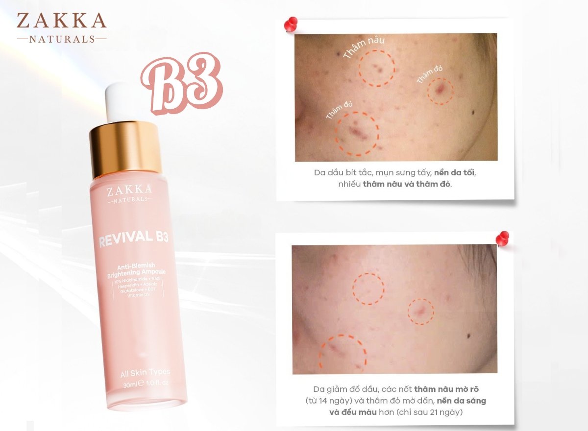 Review Niacinamide Zakka: Hiệu quả kép sáng da mờ thâm và kháng viêm