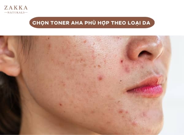 Chọn Toner AHA Phù Hợp Theo Loại Da