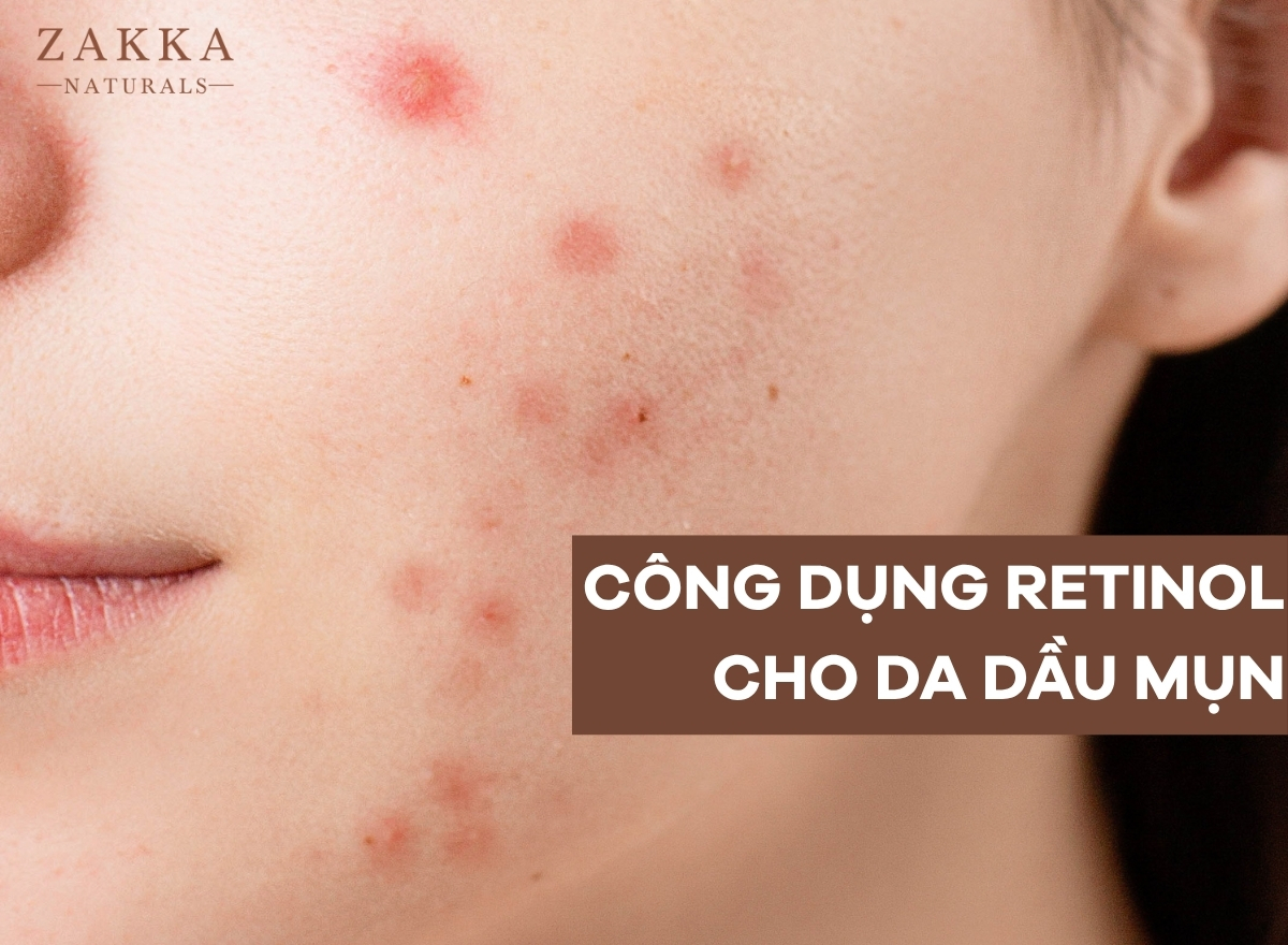 Retinol Trị Mụn? Cách Dùng Retinol Cho Người Mới Bắt Đầu?