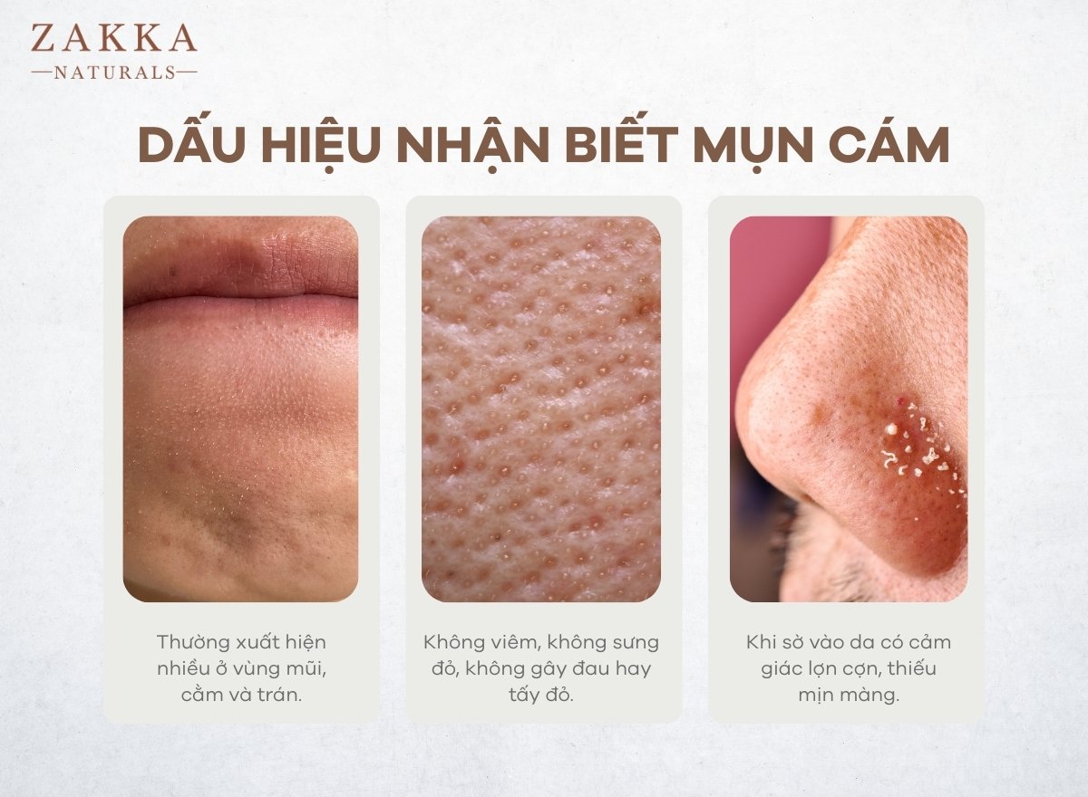 Mụn Cám Là Gì? Cách Trị Mụn Cám Tại Nhà