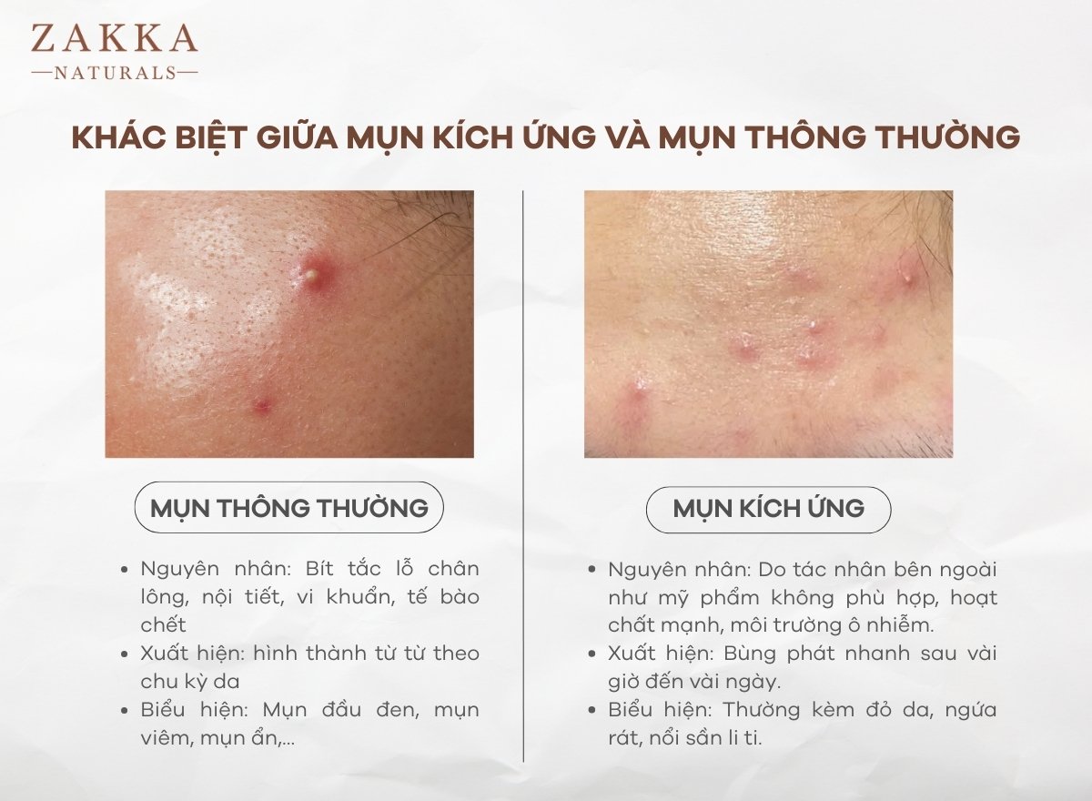 Mụn Kích Ứng Là Gì? Cách Nhận Biết Và Trị Hiệu Quả Tại Nhà