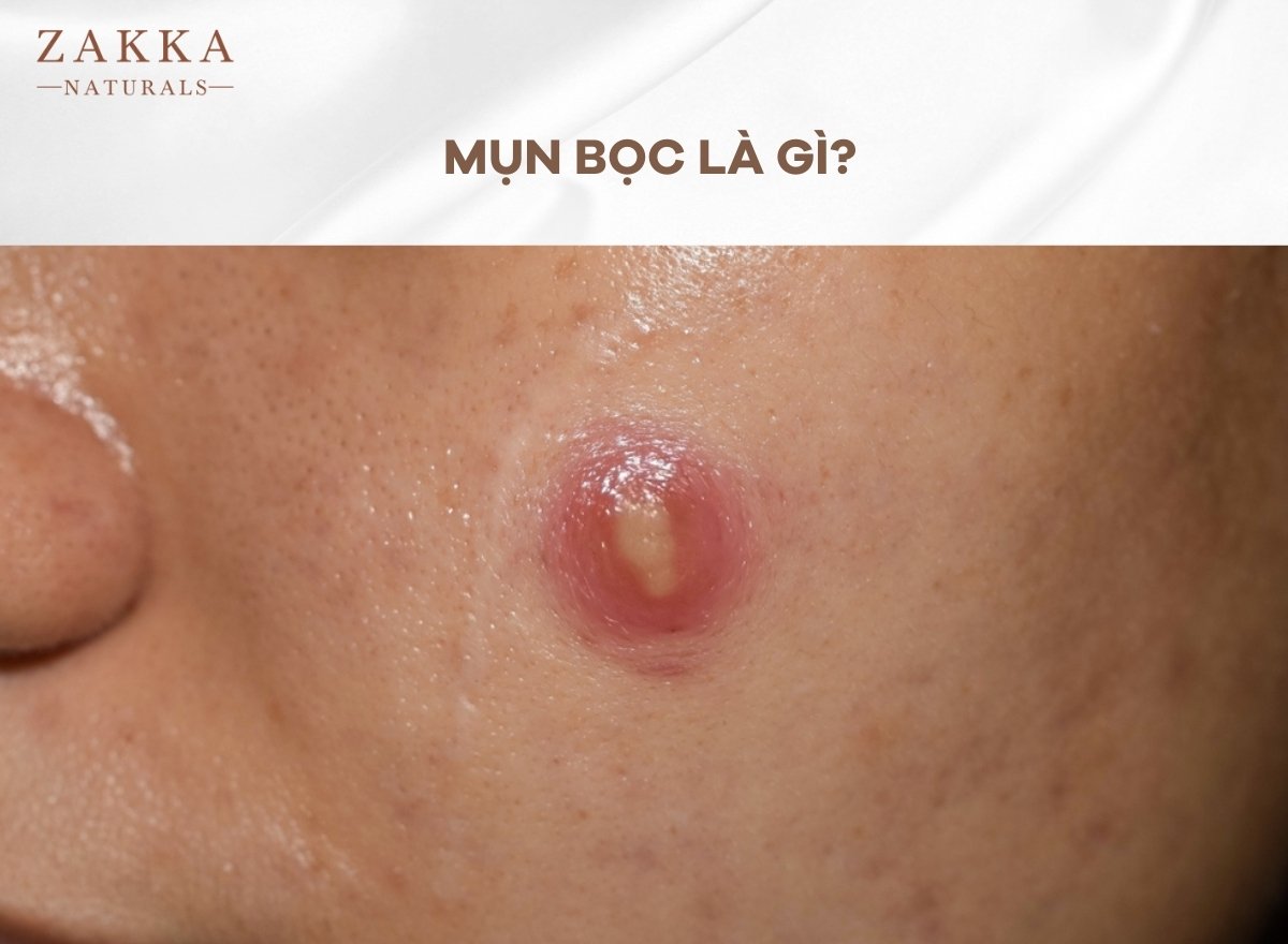 Mụn Bọc Là Gì? Nguyên Nhân, Vị Trí Thường Gặp Và Cách Điều Trị Hiệu Quả