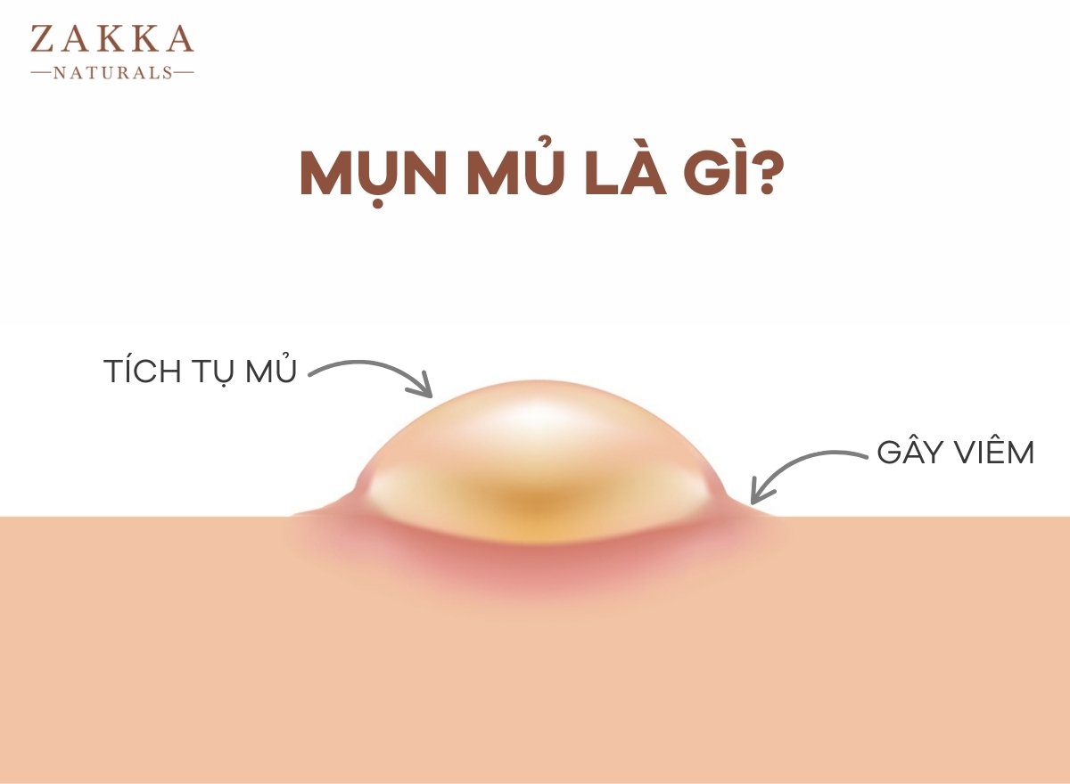 Mụn Mủ Là Gì?
