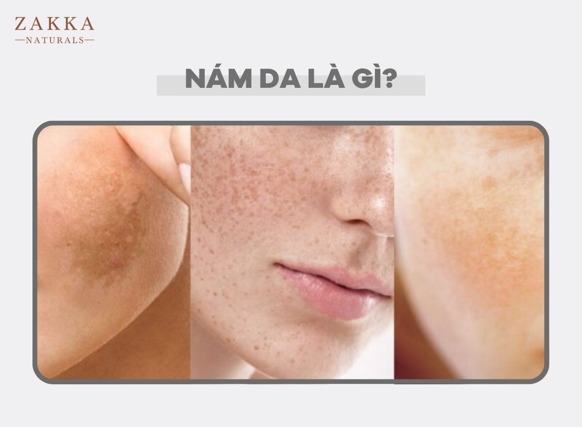 Hướng Dẫn Chi Tiết Dùng Retinol Trị Nám Hiệu Quả