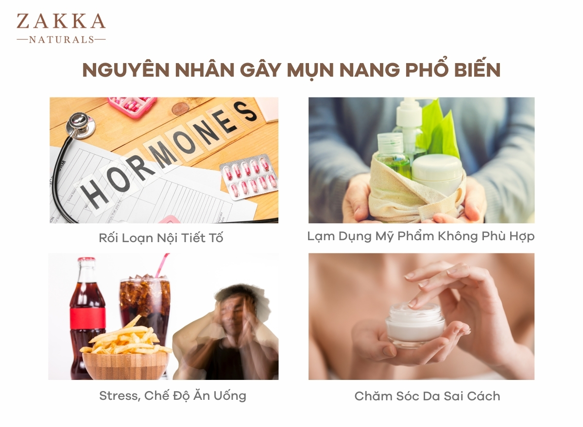 Mụn Nang: Dấu Hiệu Nhận Biết Và Cách Điều Trị Tại Nhà