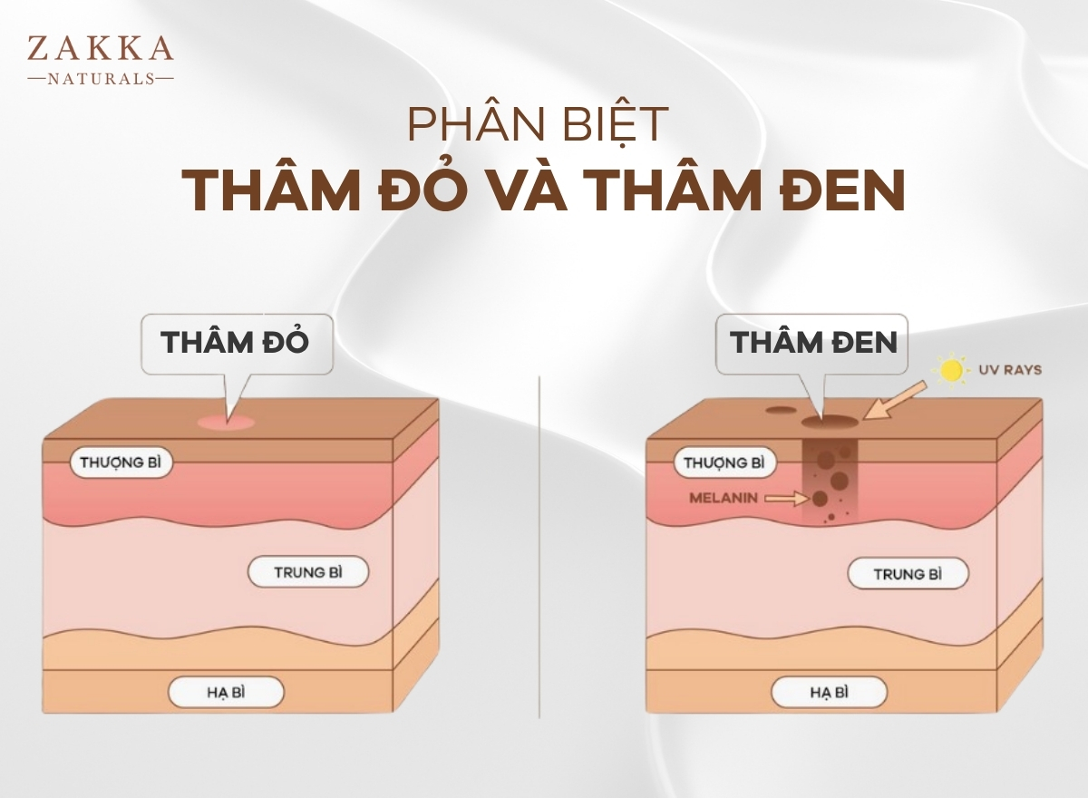Bạn có đang hiểu đúng về các nốt thâm trên da?