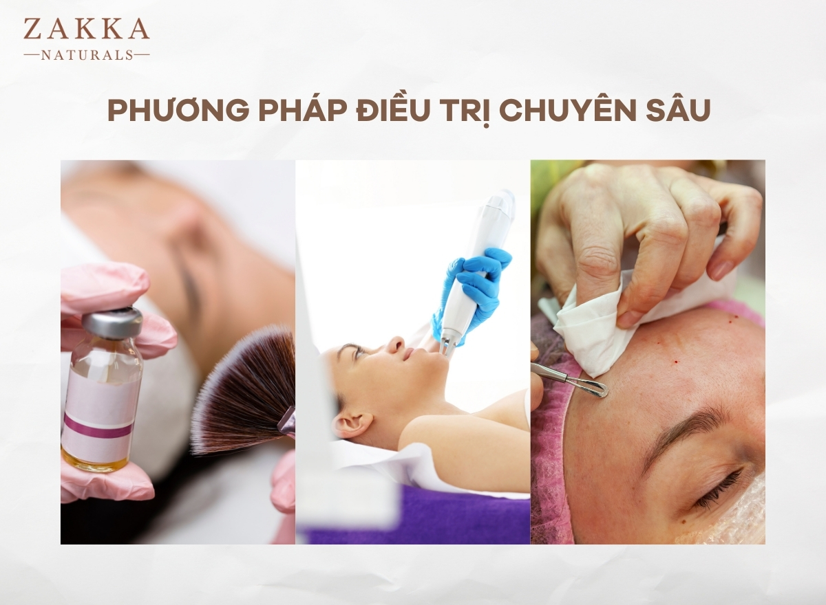 Mụn Cám Là Gì? Cách Trị Mụn Cám Tại Nhà