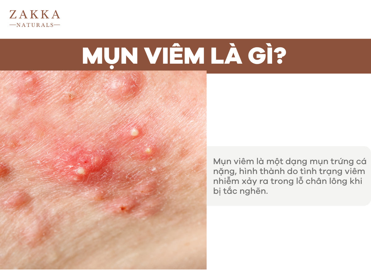 Mụn Viêm Là Gì? Cách Trị Mụn Viêm Từ Chuyên Gia