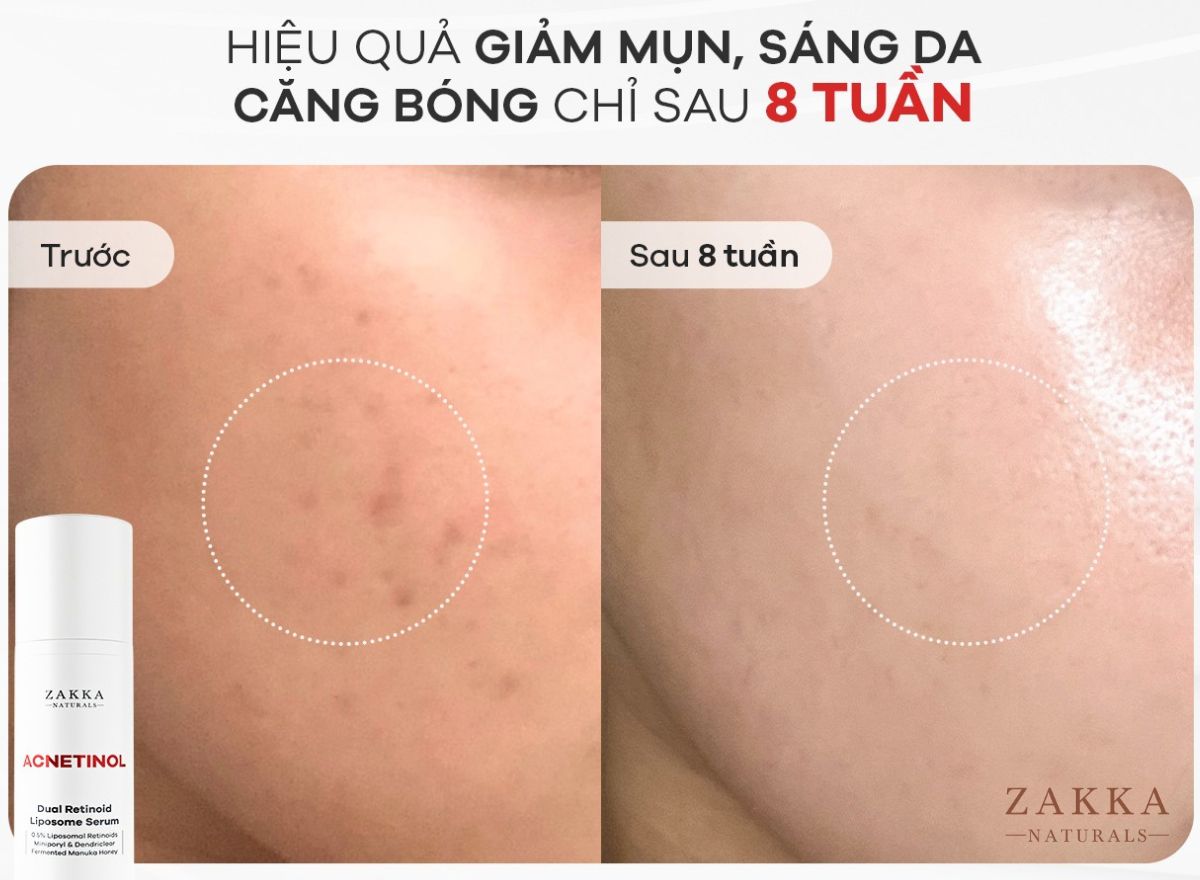 Hiệu quả trên da sau 8 tuần sử dụng Acnetinol