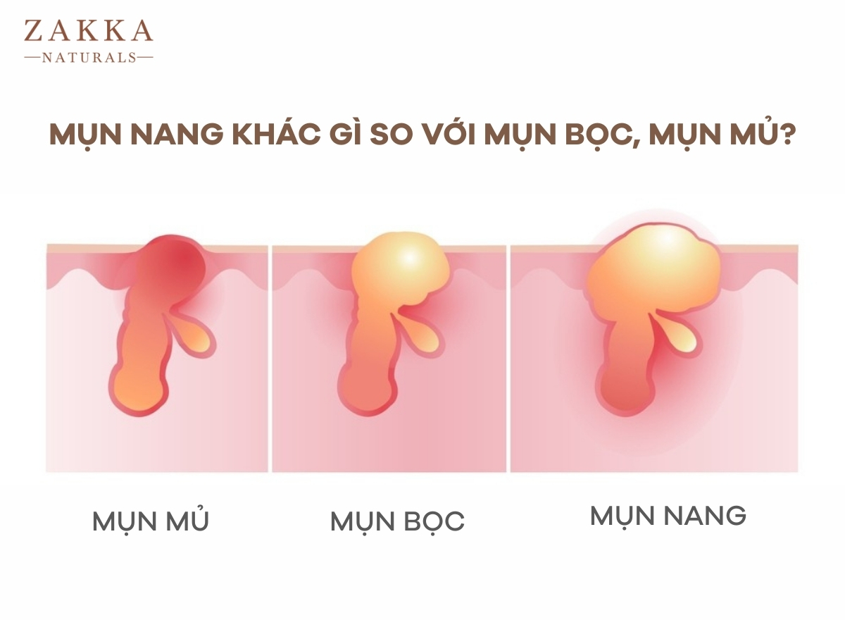 Mụn Nang: Dấu Hiệu Nhận Biết Và Cách Điều Trị Tại Nhà