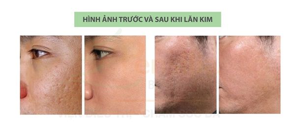 Phương pháp lăn kim trị sẹo an toàn