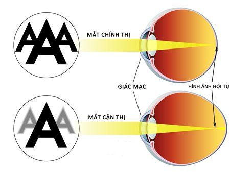 XỬ LÝ THẾ NÀO KHI HAI MẮT CẬN KHÔNG ĐỀU NHAU