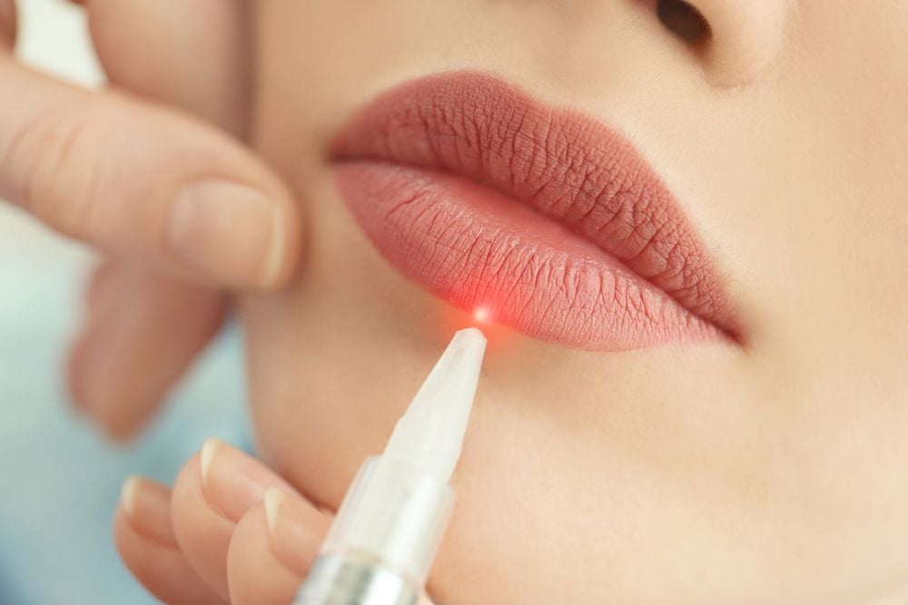 Dùng tia laser trị thâm môi