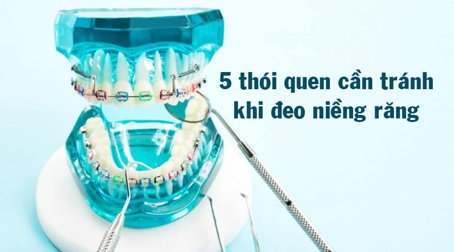 5 thói quen cần tránh khi đeo niềng răng