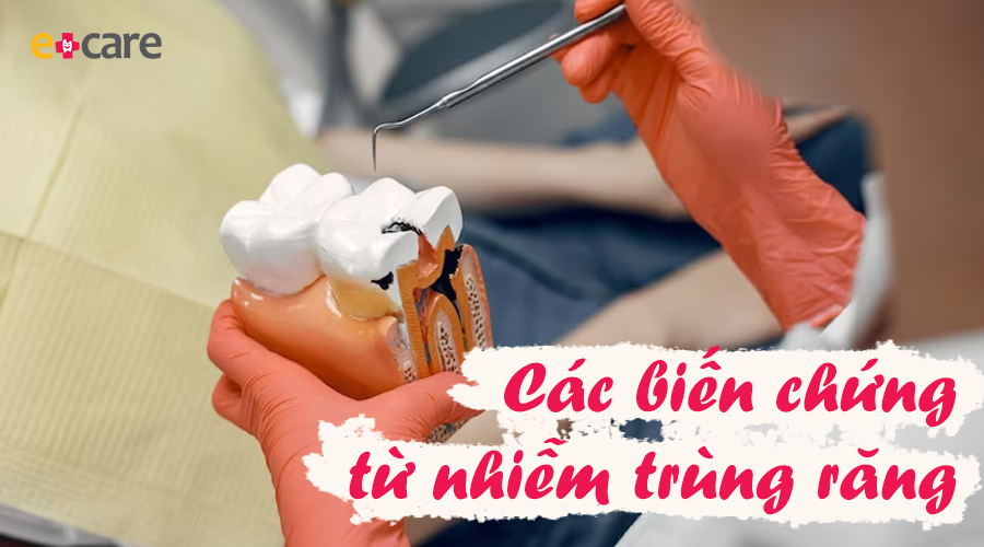 Các biến chứng từ nhiễm trùng răng