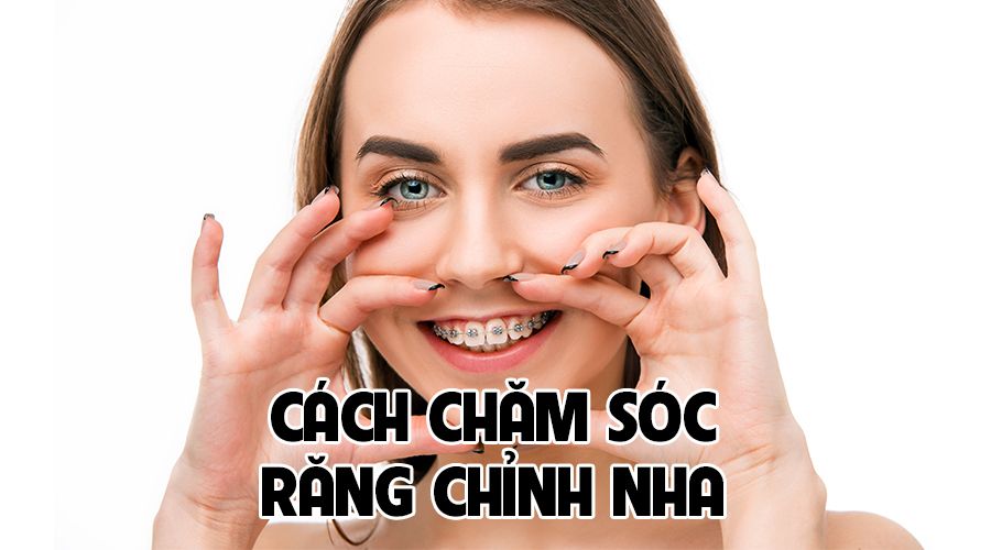 Cách chăm sóc răng chỉnh nha